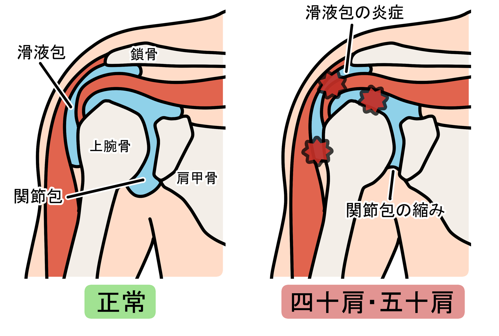 四十肩・五十肩